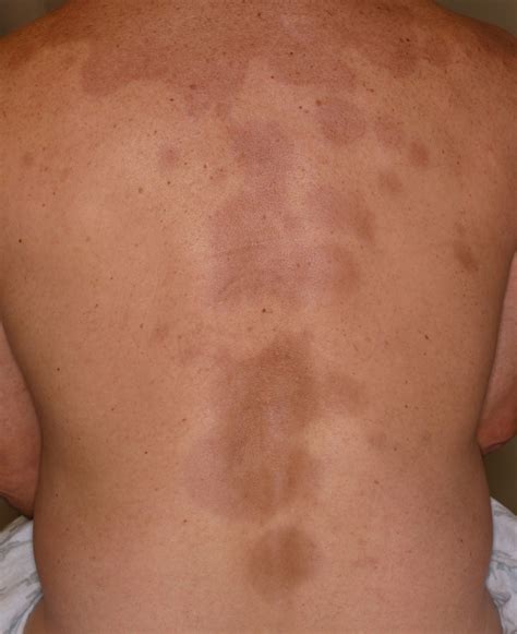 Atrophoderma of Pasini and Pierini