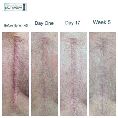 Open heart surgery scar vanishes with continued use of NeriumAD. Works so well on other scars ...