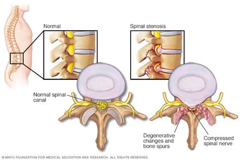 Spinal stenosis - Mayo Clinic