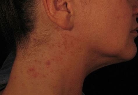 Can Vitamin b12 Injections Cause Nasty Rashes?