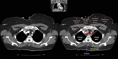 Ct Chest Anatomy Anatomical Charts Posters Sexiz Pix | The Best Porn Website