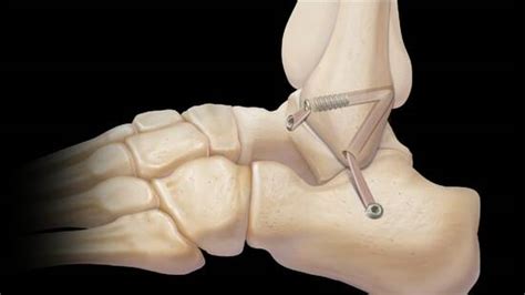 Lateral Ankle Ligament Injuries: Allograft Reconstruction of Lateral ...