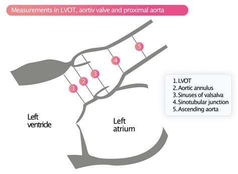 Aortic stenosis - Echocardiography, diagnosis, grading, causes, management