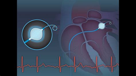 Cryoablation or Drug Therapy for Atrial Fibrillation | NEJM - YouTube