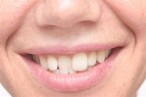 WHAT ARE THE BEST TREATMENT OPTIONS FOR MY CROOKED TEETH? - Unique ...