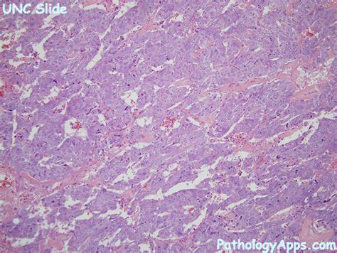 medullary carcinoma pathology