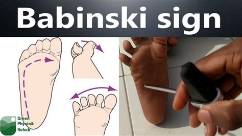 Babinski Sign/Reflex|Plantar Reflex|Green Physio & Rehab - YouTube