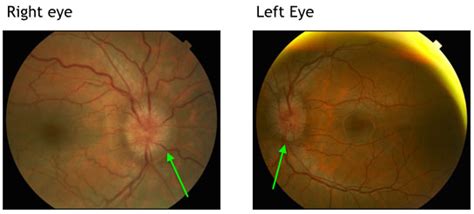 Ophthalmologist Boston | Papilledema Boston | NEEC