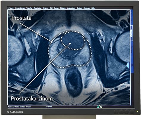 Prostatakarzinom: Früherkennung und Therapiemöglichkeiten