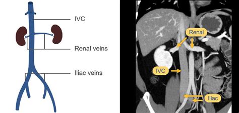 Abdominal CT: abdominal veins • LITFL • Radiology Library