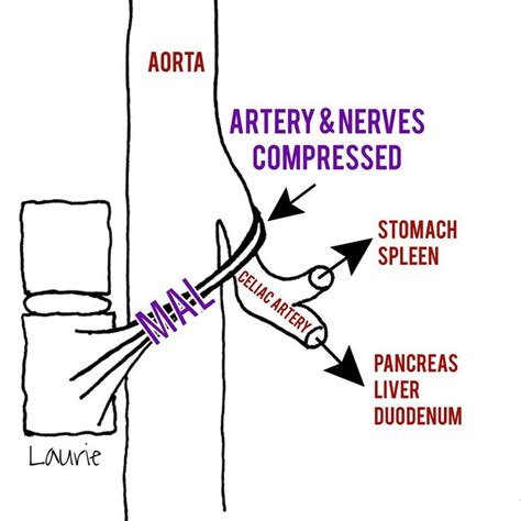 Pin on Median Arcuate Ligament Syndrome/MALS