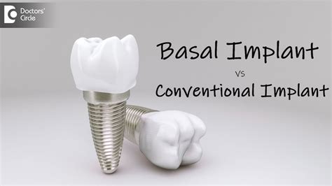 Basal Implant vs Conventional Implant - Everything You Need to Know