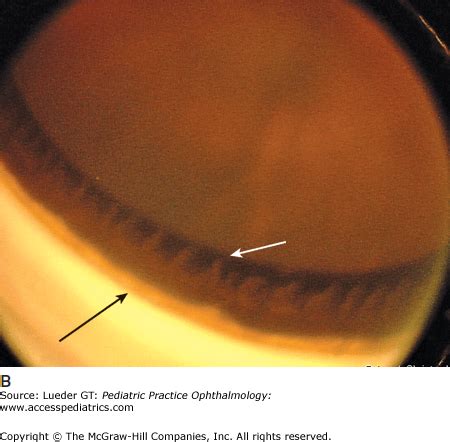 Disorders of the Iris and Pupil | Ento Key