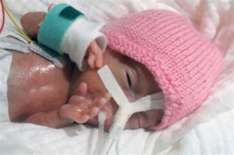 World's 'Smallest Baby' Born Weighing 8 Ounces And With Fingernail Size ...