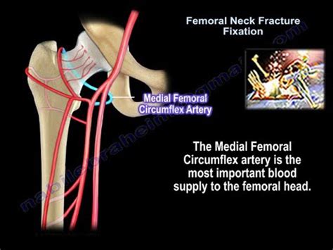 Femoral Neck Fracture Anatomy - Everything You Need To Know - Dr. Nabil ...