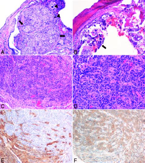 Histopathological features of the tumor. A, The tumor displayed typical ...