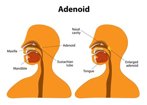 What is adenoid? Adenoid is soft tissue at the back of the throat ...