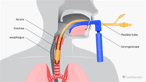 Intubation: Uses, Risks, and Recovery