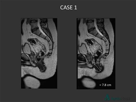 Rectal cancer staging go the full “Distance”. MRI - online presentation