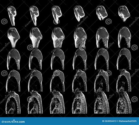 MRI of Shoulder Tumor or Mass Science and Education MRI Shoulder ...