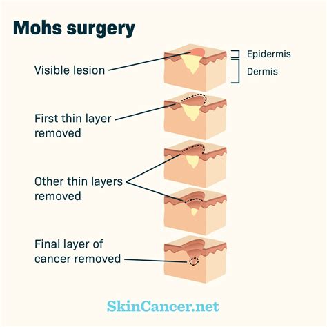 Skin Cancer Mohs Surgery - Dorset, Bournemouth, Christchurch