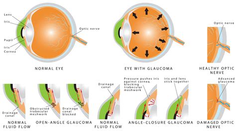 Glaucoma in Cats: Causes, Symptoms & Treatment - Cat-World