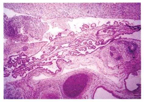 Teratoma Histology