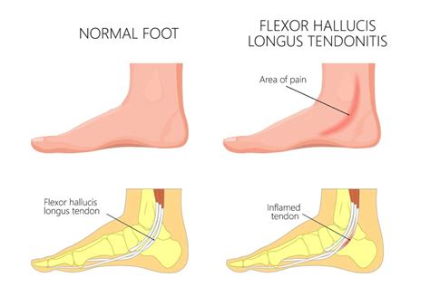 Best Posterior Tibial Tendonitis Brace [Lace Up Ankle & Foot Braces]