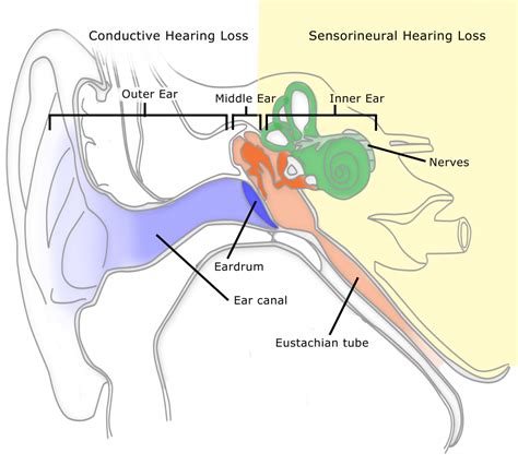 Types of Hearing loss