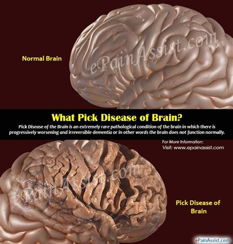 What is Pick Disease of Brain? | Picks disease, Disease, What is dementia