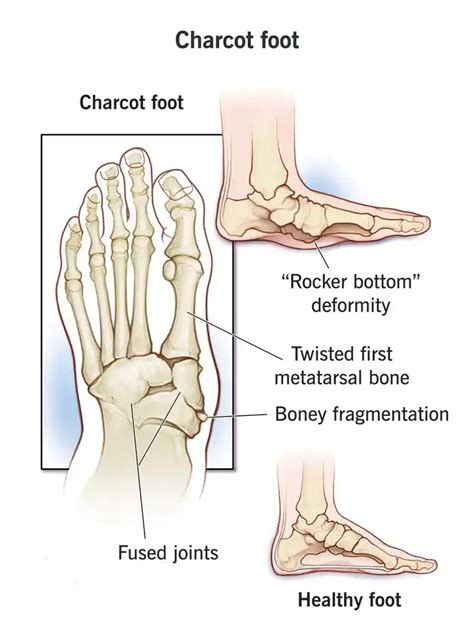 Charcot foot - Ankle & Foot Clinic-Diabetes Foot clinic India