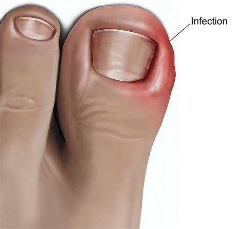 Ingrown toenails: Causes, Symptoms and Treatment