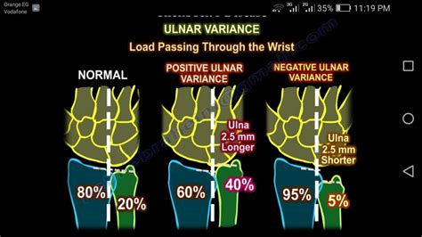 #ulnar variance