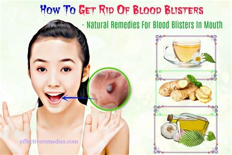 Top 17 Ways How To Get Rid Of Blood Blisters On Face & In Mouth