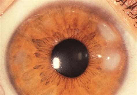 Salzmann nodular degeneration - American Academy of Ophthalmology