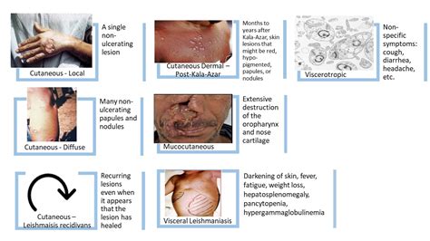 Leishmaniasis Types