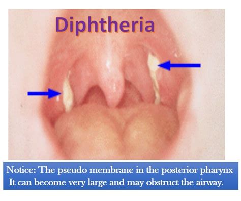 Diphtheria - MasatoTahlil