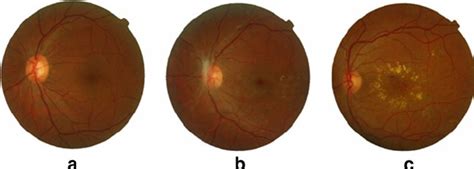 Stages of diabetic maculopathy: a healthy retinal image, b non-CSME... | Download Scientific Diagram