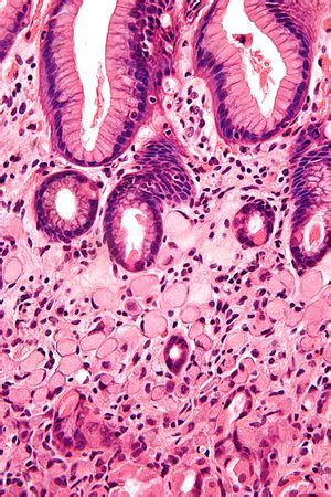 Stomach carcinoma - Libre Pathology