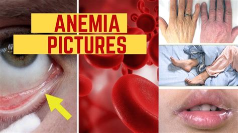 Anemia Pictures - Early Signs Symptoms Photos Images and Pictures of ...