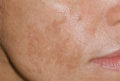 👉 Melasma - Treatment, Pictures, Symptoms, Causes (January 2022)