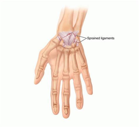 Wrist Sprain: Symptoms, Causes, Treatment By Wrist & Thumb Braces