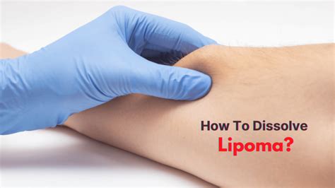 lipoma treatment without surgery - Dr. Rahul Singh