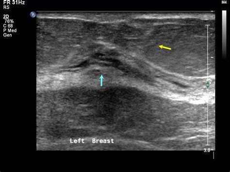 Atlas of breast cancer early detection