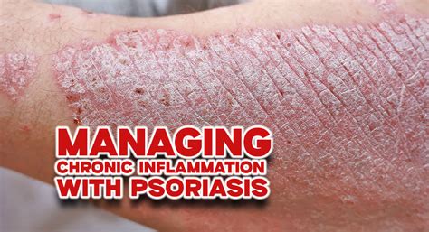 Managing Chronic Inflammation with Psoriasis - Mega Doctor News