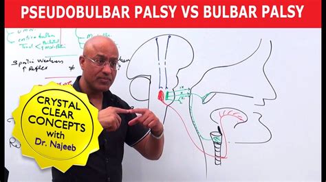 Pseudobulbar Palsy vs Bulbar Palsy - YouTube