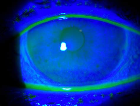 Lesson: Dry Eye Epidemiology in Practice