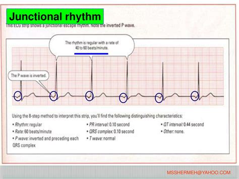 PPT - ECG INTERPRETATION PowerPoint Presentation, free download - ID ...