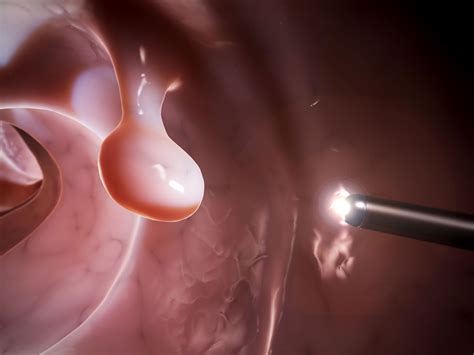 What Is a Polyp? | YourCareEverywhere