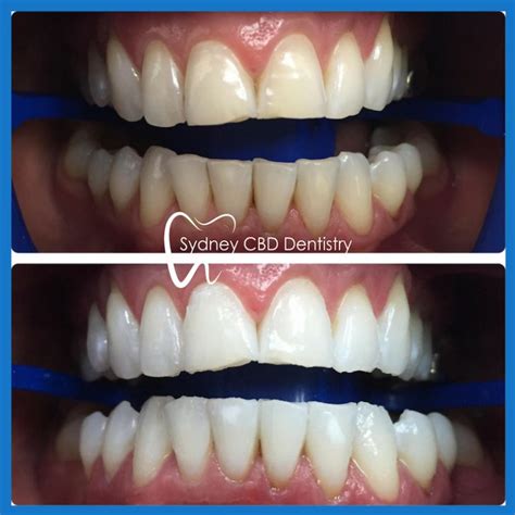 Teeth Whitening Sydney | Sydney CBD Dentistry